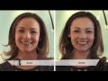 Facette Dentaire : Présentation par le Dr. Martine Zisserman