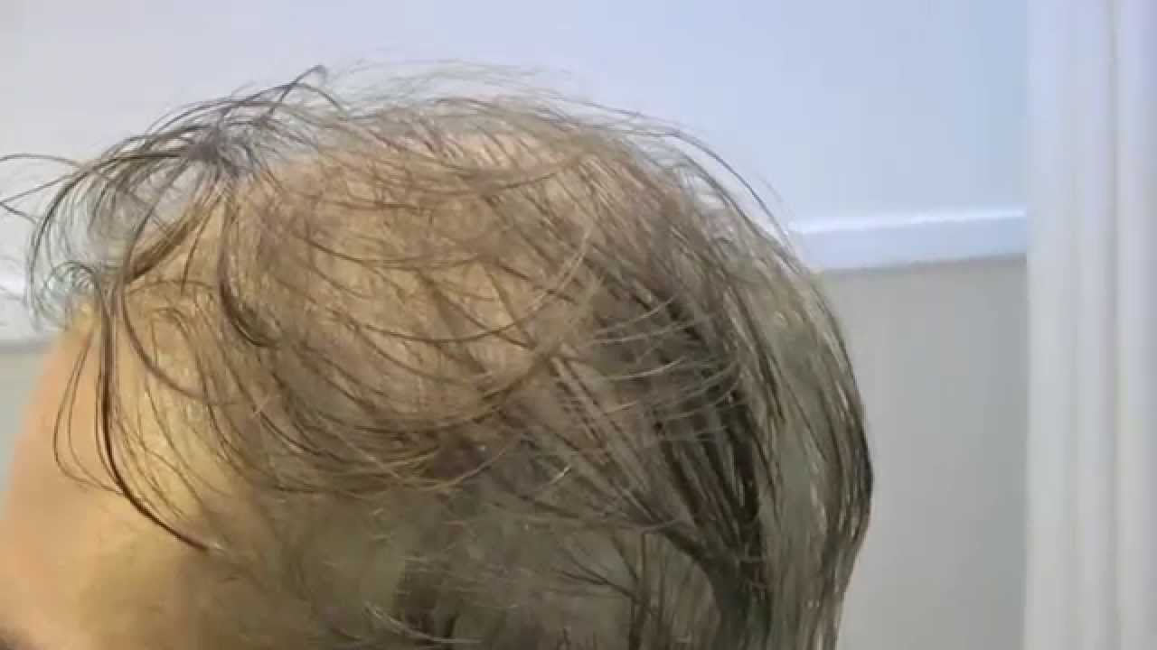 protesi capelli veri uomo