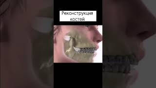 Прикус исправляют хирургическим путем. #хирургия #челюсть #прикус #косметология