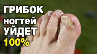 ГРИБОК НОГТЕЙ Исчезнет! 100% народное средство избавляет от грибка на ногах и руках