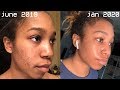 HOW I CLEARED MY ACNE + SCARS (before & after photos)