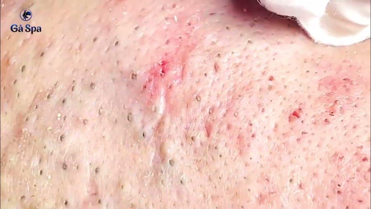 Ear blackhead professional extraction Full video of blackhead removal on ear720P HD 3 YouTube