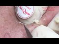 |301| Best compilation of blackheads in September 2020 - Những ca mụn hay nhất tháng 9 năm 2020