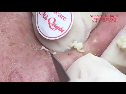 Video |301| Best compilation of blackheads in September 2020... - youtube