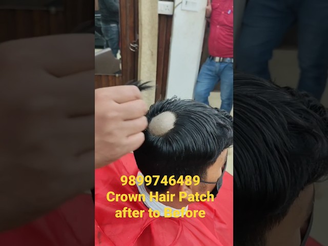 Hair Patch in Bhubaneswar | Say Goodbye to baldness with Hair Patches
