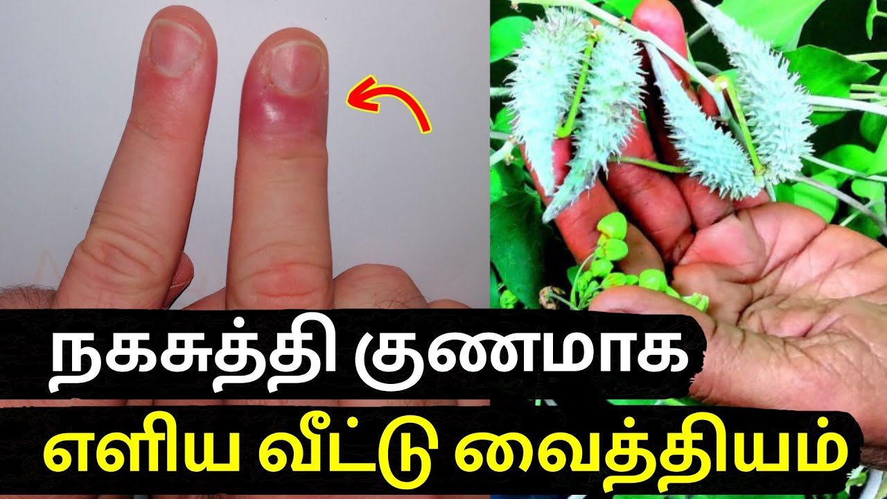 நகசுத்தி குணமாக How to cure nail Fungus Naturally in tamil Naga