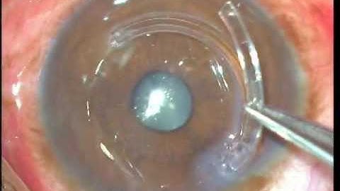 Asymmetric Intacs for keratoconus Soosan Jacob