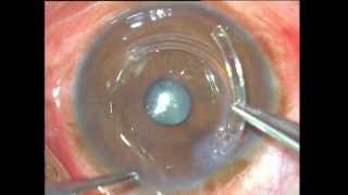 Asymmetric Intacs For Keratoconus Soosan Jacob