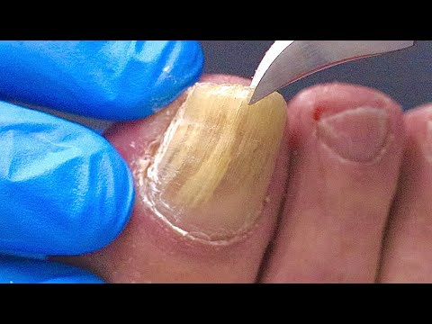 Trimming a THICK FUNGAL TOENAIL under SUPER ZOOM