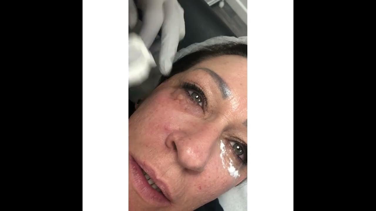 Lumi eyes treatment YouTube