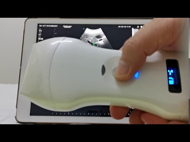 Pourquoi utiliser un scanner à ultrasons portable ? - Kalstein