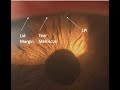 Laser Peripheral Iridotomy: Tips and Tricks (Malik Y. Kahook, MD)