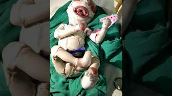 Harlequin Ichthyosis الوليد المهرج Youtube