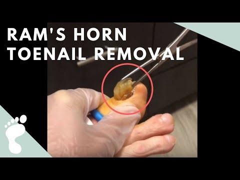 Lexington Podiatry Ram's Horn Toenail Removal