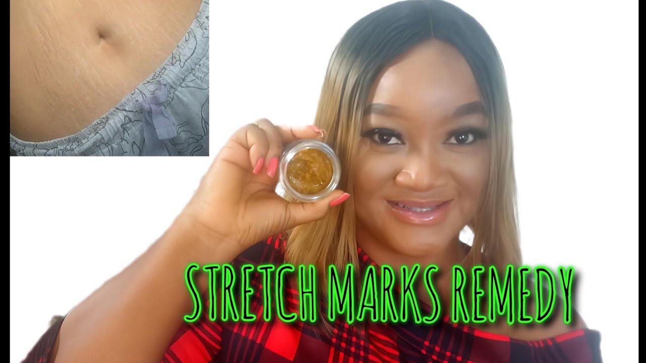 HOW TO REMOVE STRETCH MARKS HOME REMEDY| STRETCH MARKS CREAM