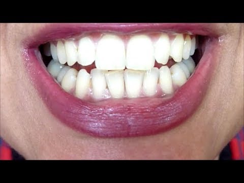 does-activated-charcoal-toothpaste-whiten-teeth