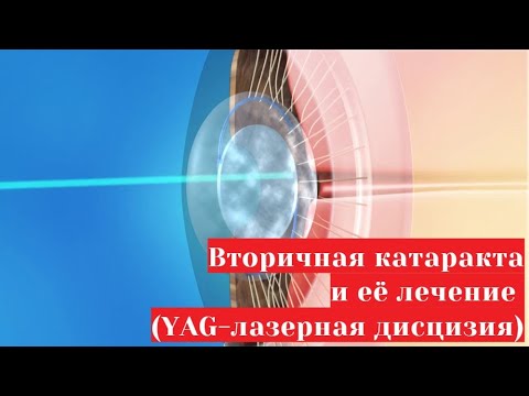 Вторичная катаракта и её лечение - 👀💥 YAG лазерная дисцизия задней капсулы хрусталика