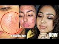 *one product to cure my acne* skincare routine (INEXPENSIVE &amp; SIMPLE)