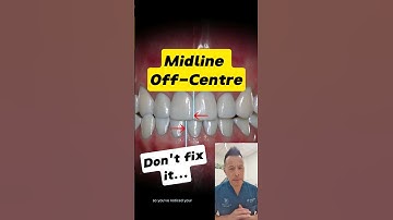 Why Your Off-Center Midline Is No Big Deal! #dentallan #dentist #shorts