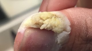 What Is It?   Cyst, Wart, Ingrown Hair, Infected Boil?