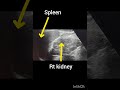 Ultrasound abdomen! Ultrasound showing ledt Kidney and spleen#ultrasoundmadeeasy86#viralshort#india
