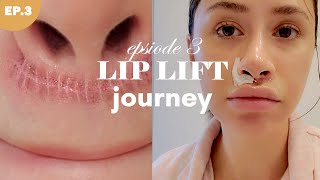 LIP LIFT SURGERY ? Episode 3 - This scar is not healing right