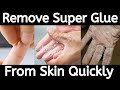 How to remove Super Glue from Skin | How to get Super Glue off Skin | How to remove Super Glue