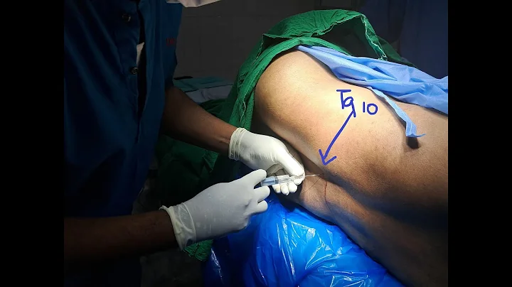 Segmental thoracic spinal anaesthesia | Dr.S.Parthasarathy MD., DNB, PhD