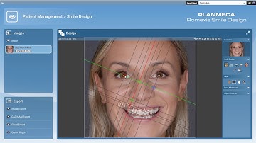 5.3. Smile Design - New photorealistic tools