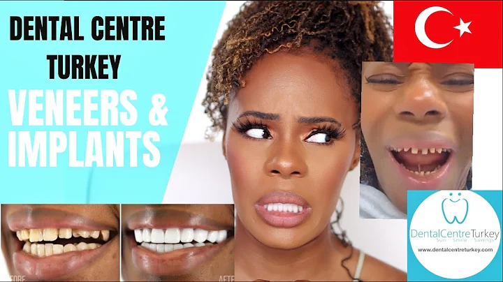 I HAD MY TEETH DONE IN TURKEY!? PART 1 |  DENTAL CENTRE TURKEY |  Hollywood Smile Makeover | Veneers