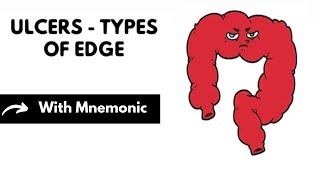 Ulcers - Type Of Edges With Mnemonic | Surgery Mnemonics | Dr Mubashar Ata screenshot 5