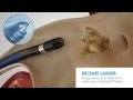 Kidney stones removing in latest technology