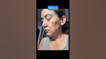 EPIC 1 YEAR FACELIFT TRANSFORMATION (Journey)