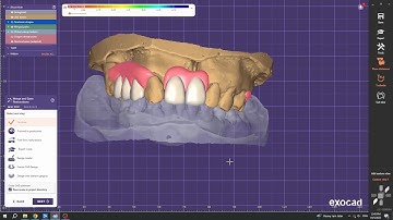 Exocad Flexible Denture Design For Upper Arch (5 Teeth)