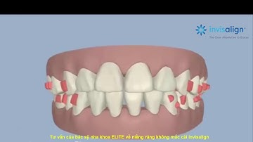 Invisalign Việt Nam - Tư vấn niềng răng không mắc cài Invisalign của nha khoa ELITE