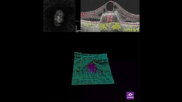 An Egg shaped Macular Neovascularization video