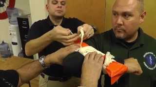 Elbow fracture and the A-Frame Splint