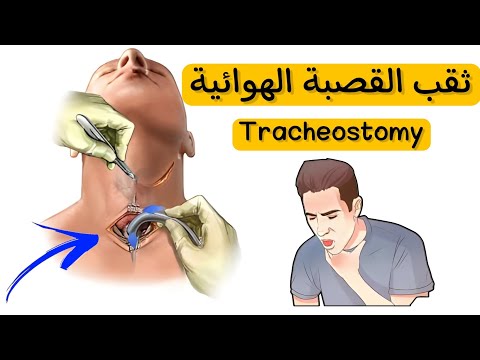 متي نلجأ لثقب القصبة الهوائية  وما هي مضاعفاتها