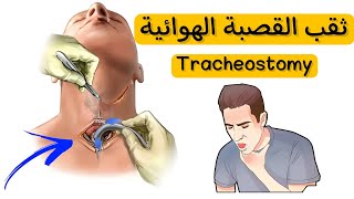 متي نلجأ لثقب القصبة الهوائية Tracheostomy | وما هي مضاعفاتها screenshot 3