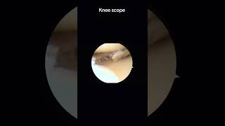 Watch a Knee Scope