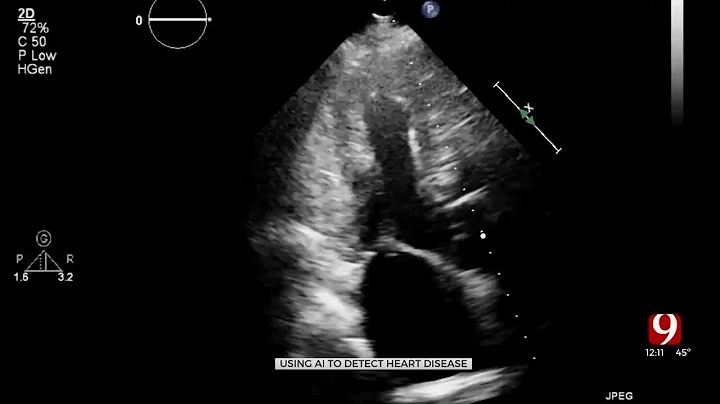 U.K. Scientists Use AI To Detect Heart Disease