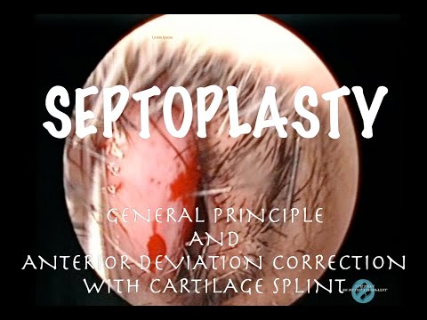Video: Septoplasti - Petunjuk, Kontraindikasi, Teknik
