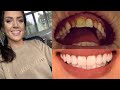 My Smile Transformation – Getting Composite Veneers!