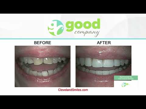 Dr. Steve Marsh Discusses Fixing Chipped, Broken, or Worn-Down Teeth