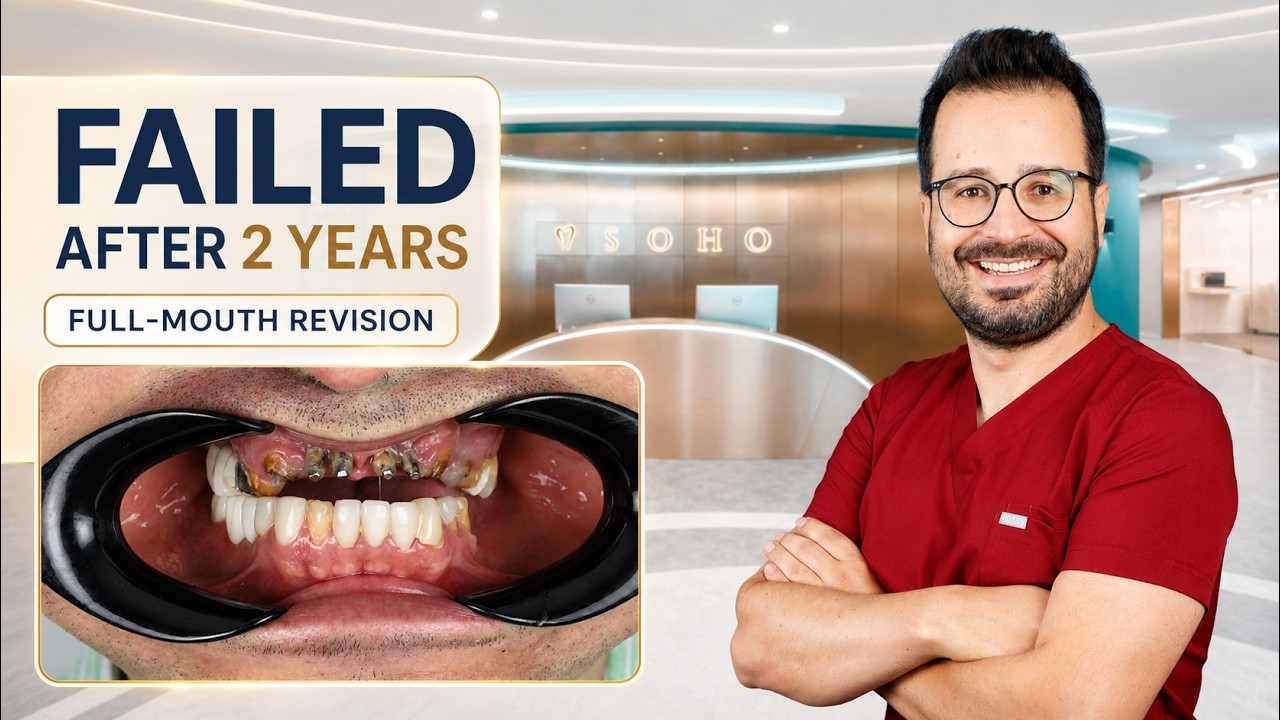 Failed Full-Mouth Implants After 2 Years: Bone Loss, Infection & Revision Case