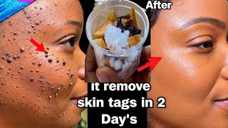 diy skin tag removal in 3 day quickly, how to remove skin tag removal with lemon in 3 day quickly,