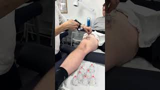 Behind the scenes 🎥 on our Myofascial Dry Cupping day course - #drycupping