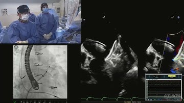 LIVE CASE 9 - Left Atrial Appendage Closure using Amplatzer Amulet