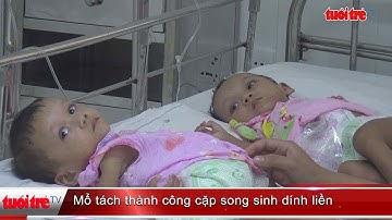 Mổ tách thành công cặp song sinh dính liền  | Truyền Hình - Báo Tuổi Trẻ