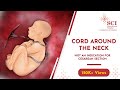 Cord Around the Neck - NOT an Indication for Cesarean Section - Dr Mamta Goel at SCI Hospital